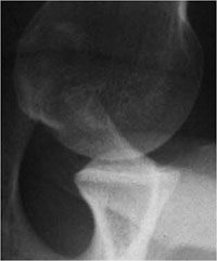 normal contralateral radiograph