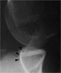 Bernageau glenoid profile radiograph shows anterior bone loss