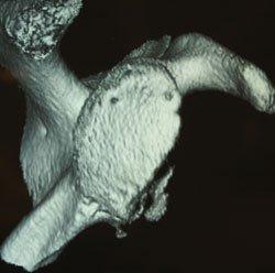 Sagittal 3-D CT reconstruction with humerus removed in a 25-year-old male after arthroscopic instability repair with recurrent anteroinferior instability.