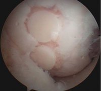 Two transferred osteochondral plugs are transferred to the eburnated surface.