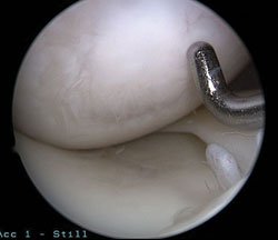 Arthroscopic photo showing excellent fill and integration of hyaline-like tissue