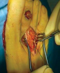 Sectioning extensor digitorum brevis tendon.