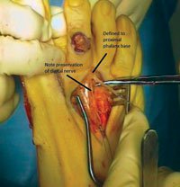 The extensor brevis must be defined as an independent tendon distal to the transverse metatarsal ligament.