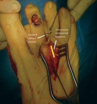 use a looped tendon passer to pass the extensor digitorum brevis tendon from distal to proximal, deep to the transverse metatarsal ligament. 