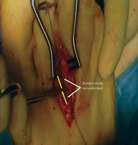 The tendon ends are then tied securely back upon themselves by the non-absorbable suture. 