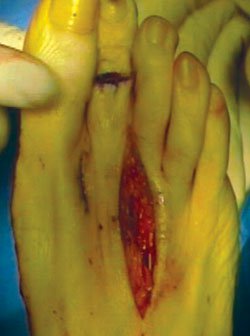 the finished reconstruction prior to completing bunion correction.