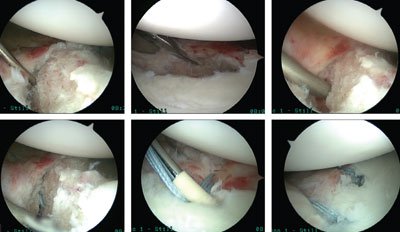 Shown here is a double row type labral repair that compresses the bone fragment against its anatomic detachment site.