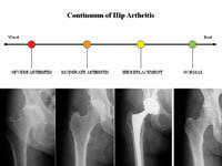 continuum of hip arthritis