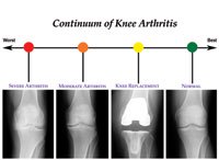 continuum of knee arthritis