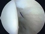 The infraspinatus tear has been repaired with a single PDS suture.