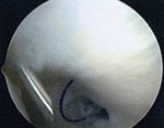 A high-grade infraspinatus tear is shown here. 