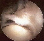 A type II SLAP tear