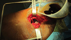 Application of dilute betadine is shown at the end of a total hip arthroplasty.