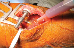 Application of dilute betadine is shown at the end of a total knee arthroplasty.