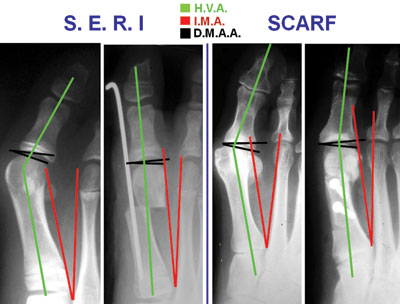 intermetatarsal and distal metatarsal angles in patients who underwent the SERI and scarf techniques