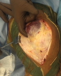 Blount dissection is used to isolate the posterior border of the VMO.