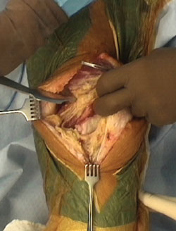 A Holmann retractor is used to elevate the pouch off of the anterior femur.