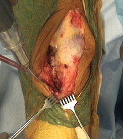 A pin is placed in the medial edge of the patellar tendon.