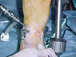 Wrist arthroscopy with the arthroscope in the 3-4 portal and cannula in the 4-5 portal