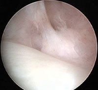 Arthroscopic visualization of the TFCC 