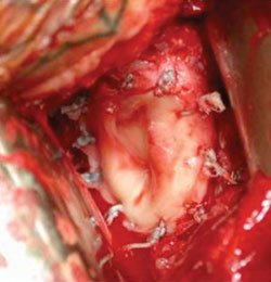 Lateral meniscal allograft is sutured in place over the glenoid to serve as a biologic resurfacing.