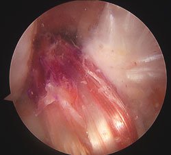 Surgeons performed an ACL reconstruction with hamstring autograft as indicated in this arthroscopic image.