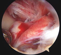 Arthroscopic view of the ACL rupture is shown here.