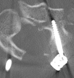 A postoperative axial CT of left C2 pedicle screw