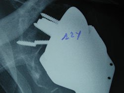 The only case of aseptic loosening of the base plate with a broken screw at 12-year follow-up leading to a prosthetic revision with implantation of a classic meta-glenoid was seen because of a fair bone stock and an efficient primary grip after impaction.