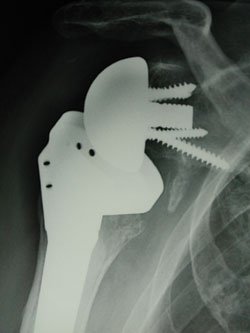 Eleven notches were stable (52%) without worrisome humeral images (impingement between the humeral component and the pillar of the glenoid or micro-movements of the lower screw).