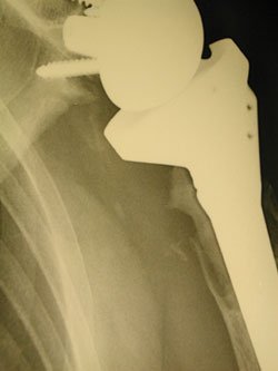 Ten patients were progressive with four proximal humeral bone losses and six radiolucent lines (polyethylene disease or osteonecrosis related to devascularization because of trauma or the surgical technique). 