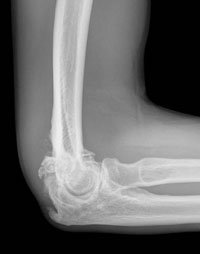 large osteophytes and loose bodies typically seen in degenerative arthritis cases