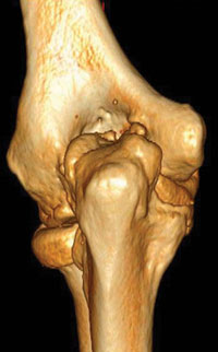 3-D CT reconstruction image