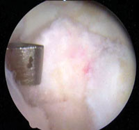 arthroscopic debridement 