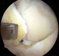 removing the olecranon osteophyte using a small osteotome