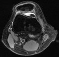 preseason MRI of a senior female basketball player with changes of the patella