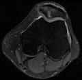 postseason MRI of a junior female basketball player with bone marrow edema in the patella