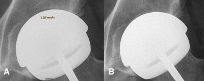 An unseated acetabular component