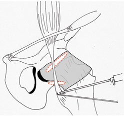 The relation between the iliopsoas tendon and the anterior hip capsule in a left hip