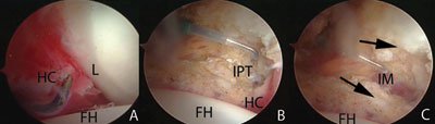 The relation between the iliopsoas tendon and the anterior hip capsule in a left hip