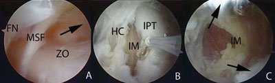 Arthroscopic sequence of a transcapsular peripheral release is shown in the left hip without traction