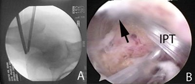 the iliopsoas tendon