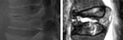 intravertebral cleft on radiography