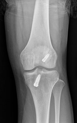 ACL reconstruction that used a bone-tendon-bone autograft