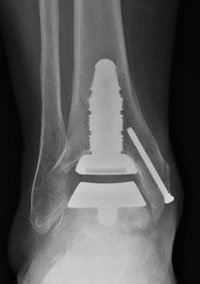 This postoperative X-ray