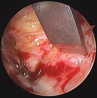 A plafondplasty resection