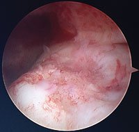 An osteochondral lesion 