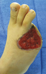 a traumatic open amputation with granulating wound