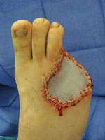 Split thickness skin graft