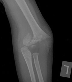 A type III supracondylar fracture in a 2-year-old child